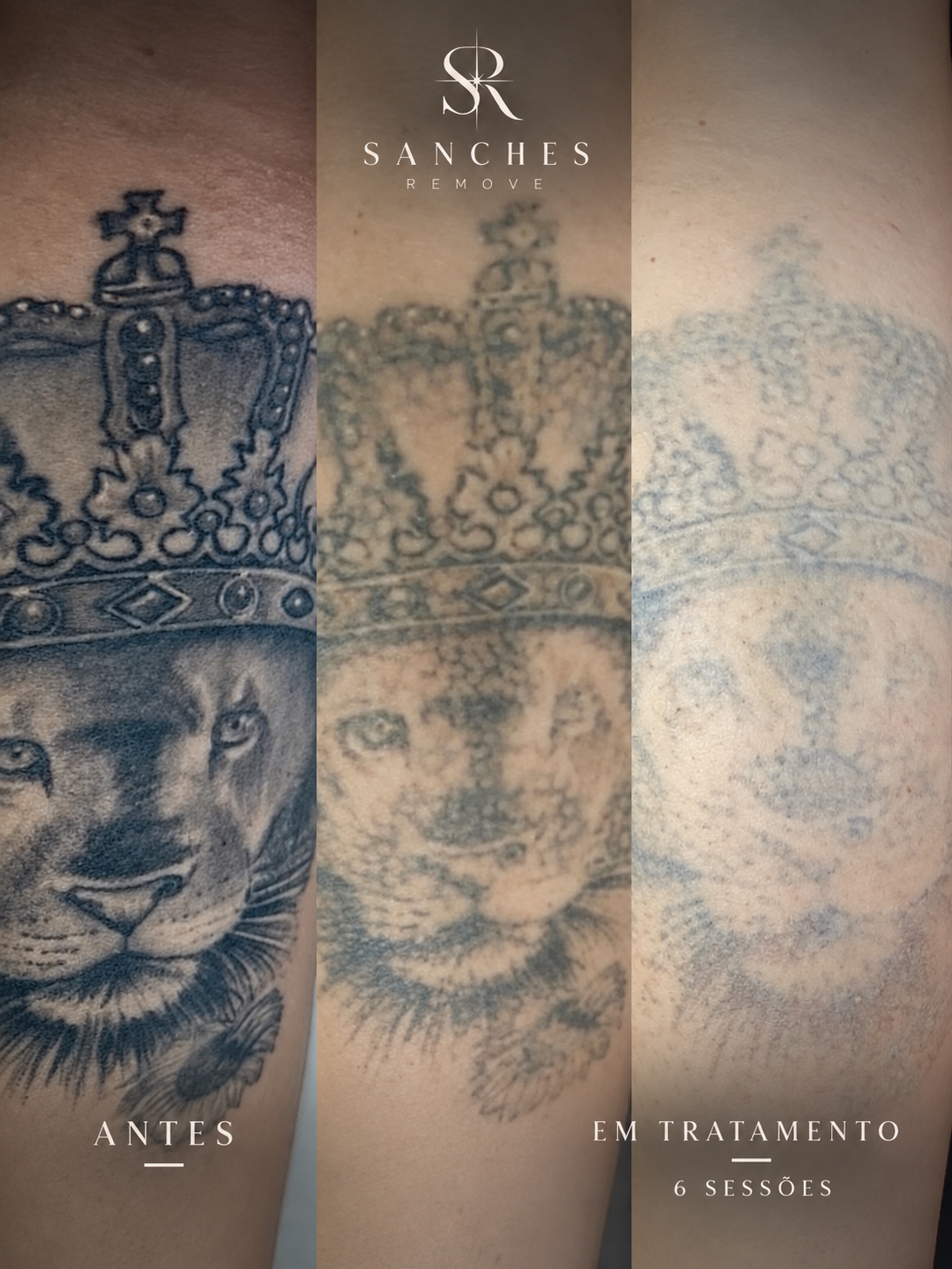 Evolução da remoção de tatuagem após 6 sessões