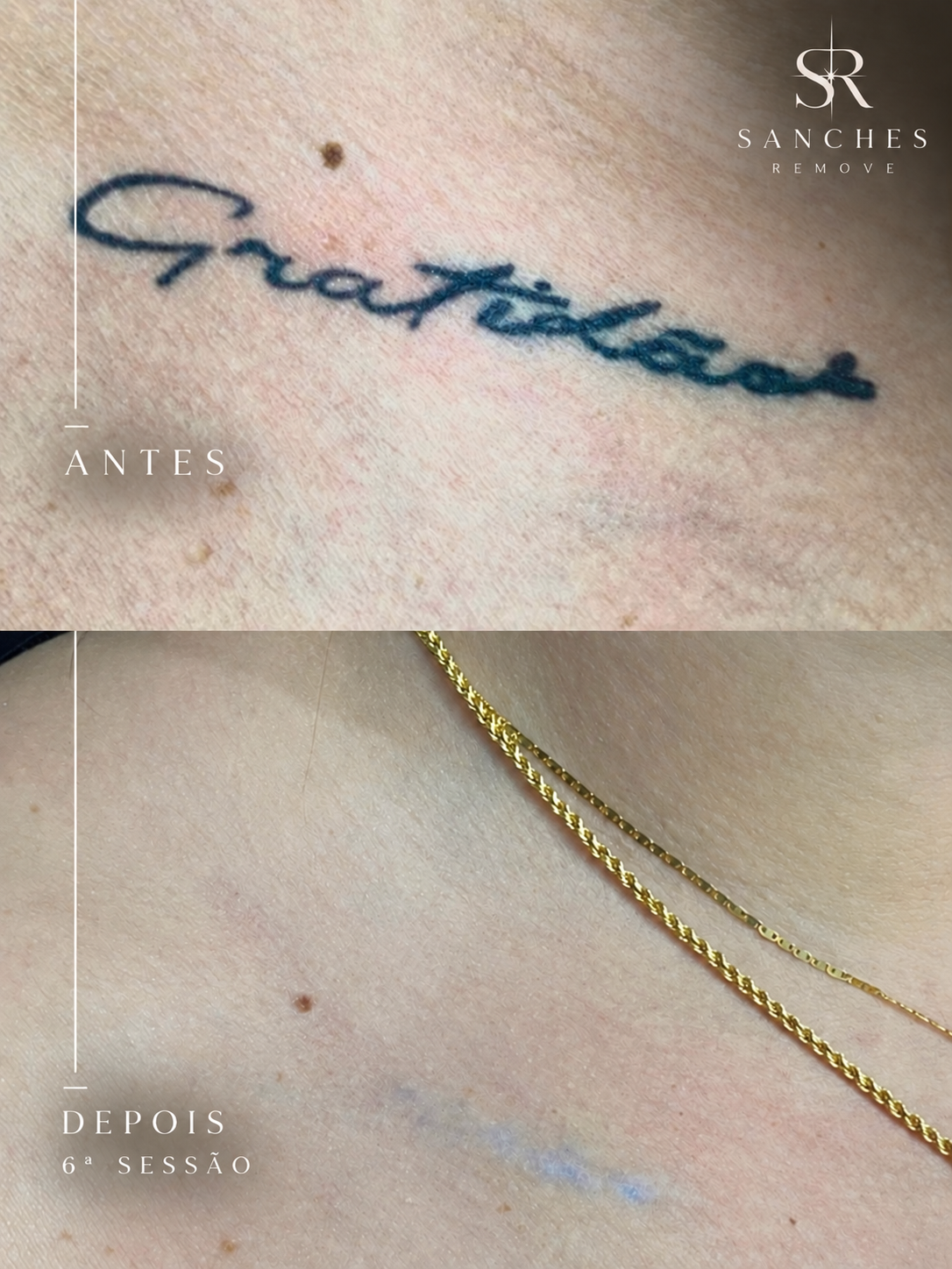 Resultado da remoção de tatuagem após 6 sessões